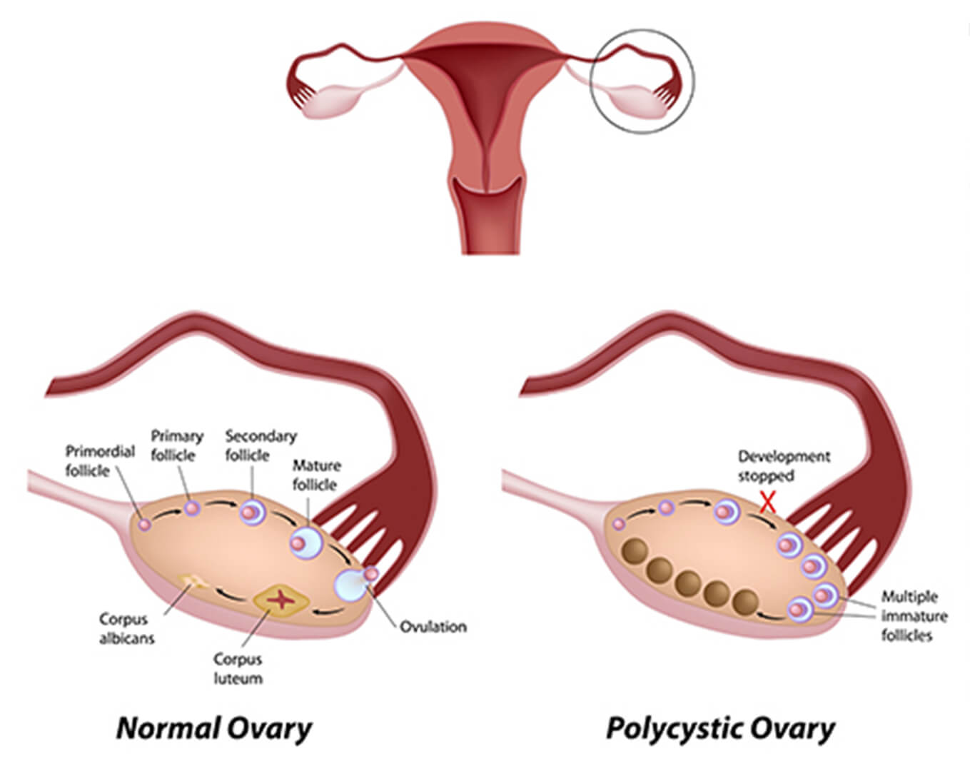 Polycystic Ovary Diagram