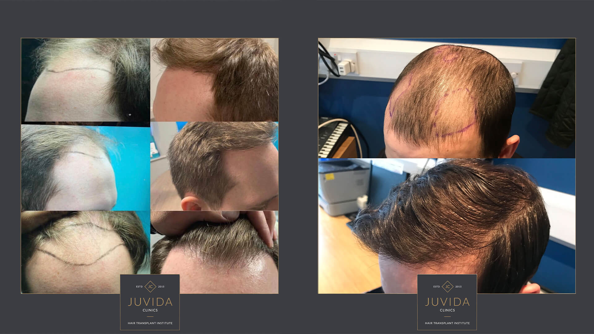 juvida hair transplant institute