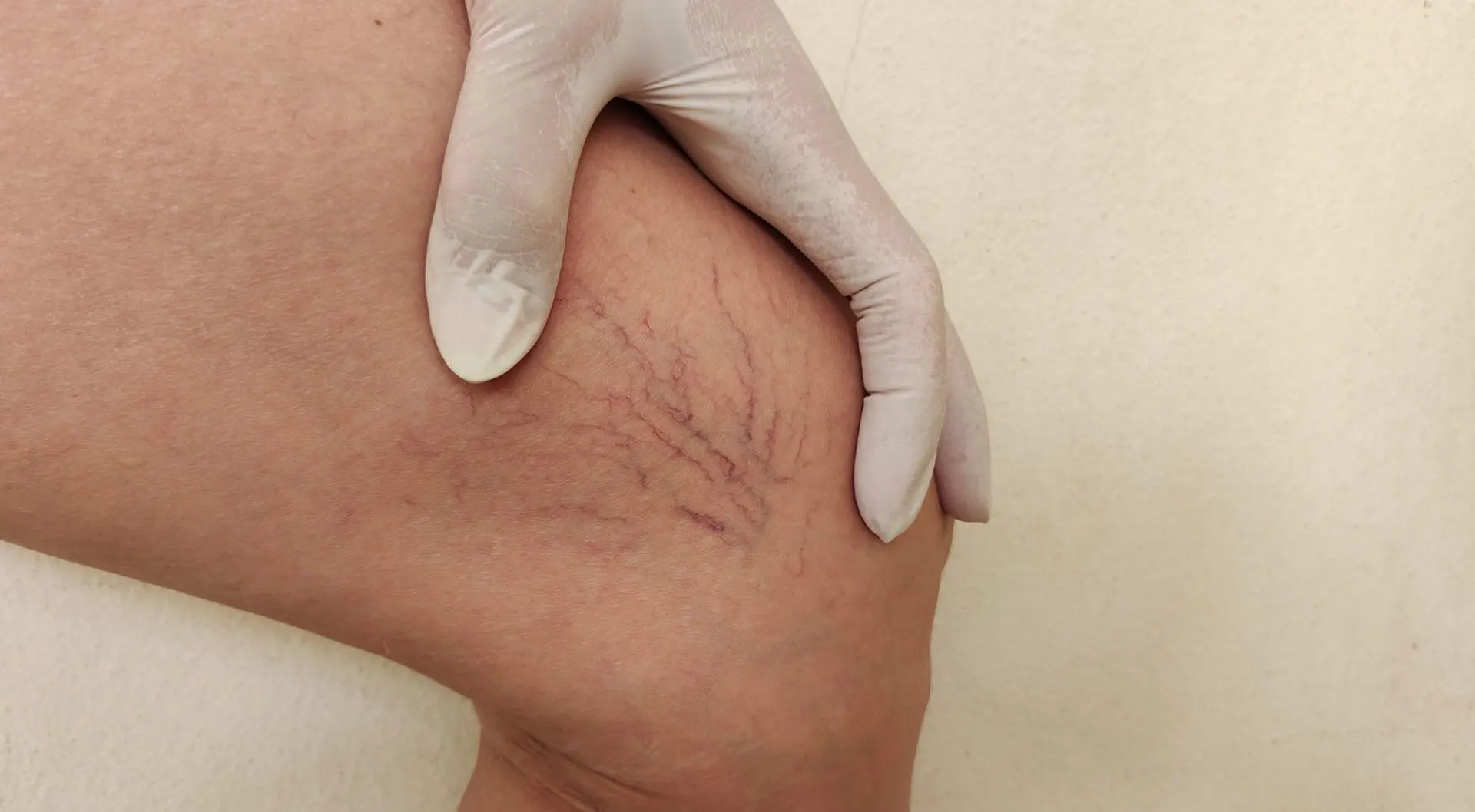 Vein disease
